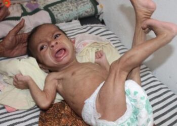 Prevalensi Stunting Di Bone Melonjak, Sibulue Posisi Tertinggi
